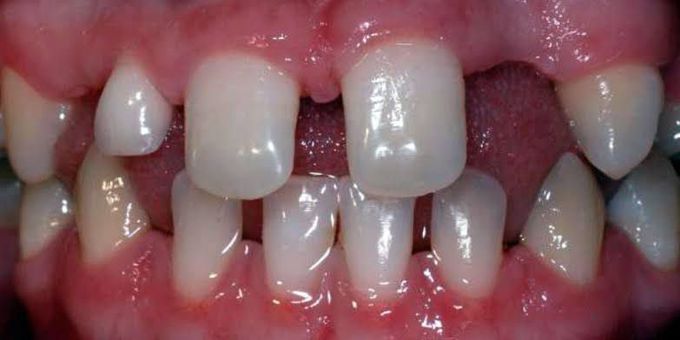 What causes hypodontia?