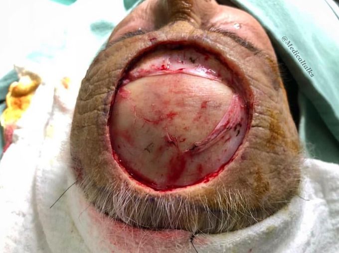 Mohs surgery