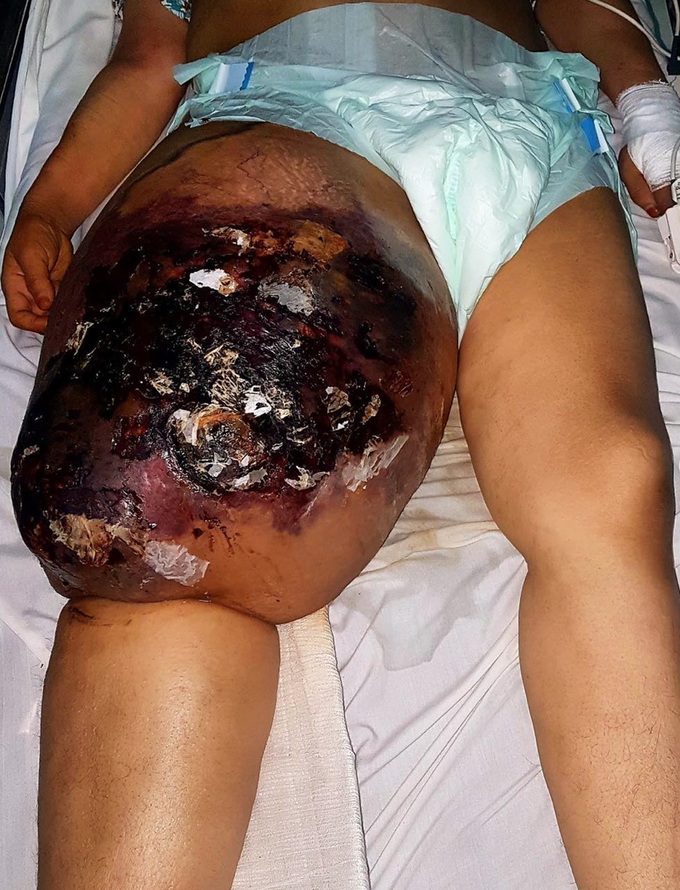Extremely rare case of leimyosarcoma of the thigh!!
