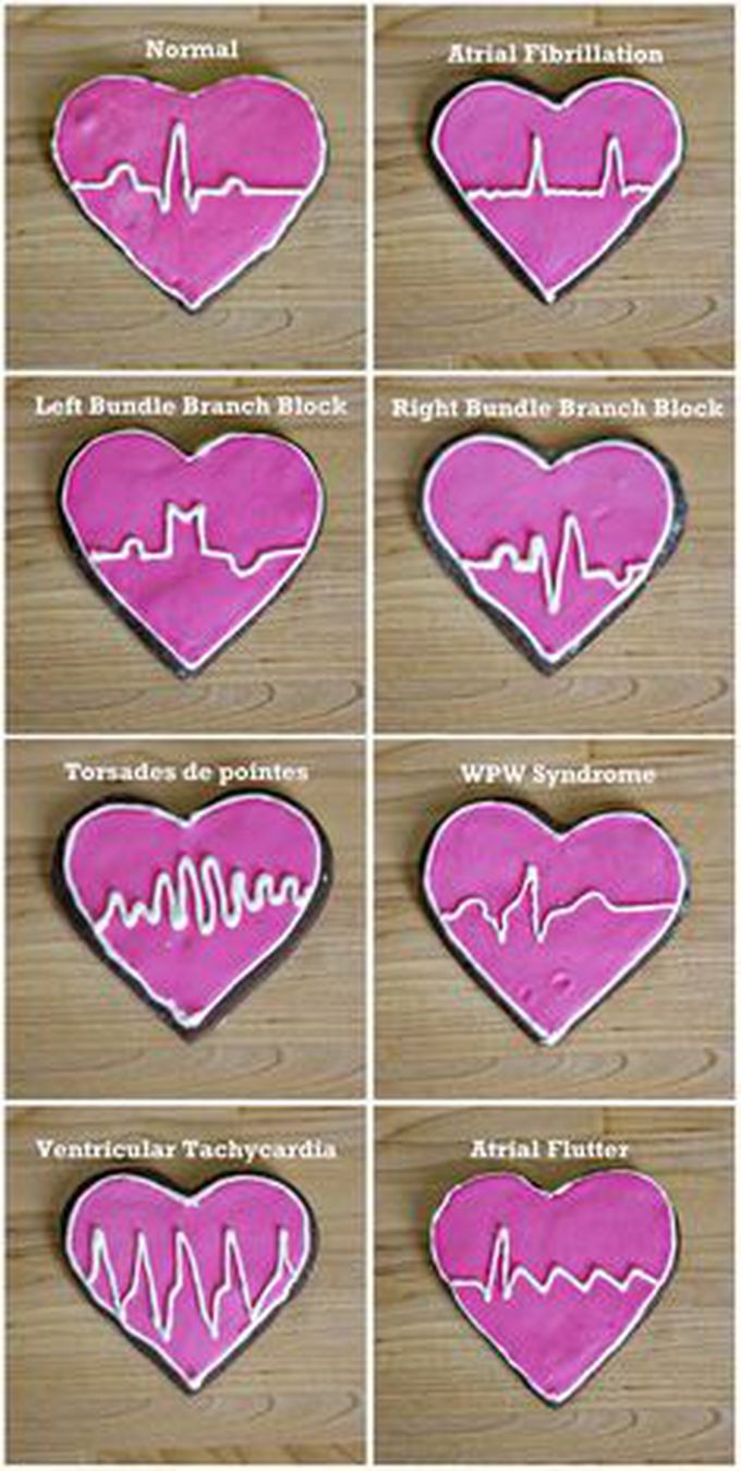 ECG for some conditions