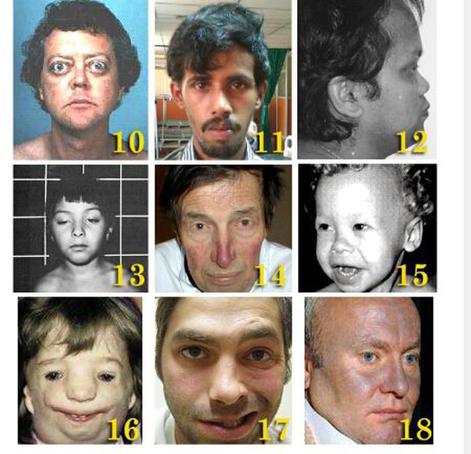 Value of face to determine the disease (part 2)