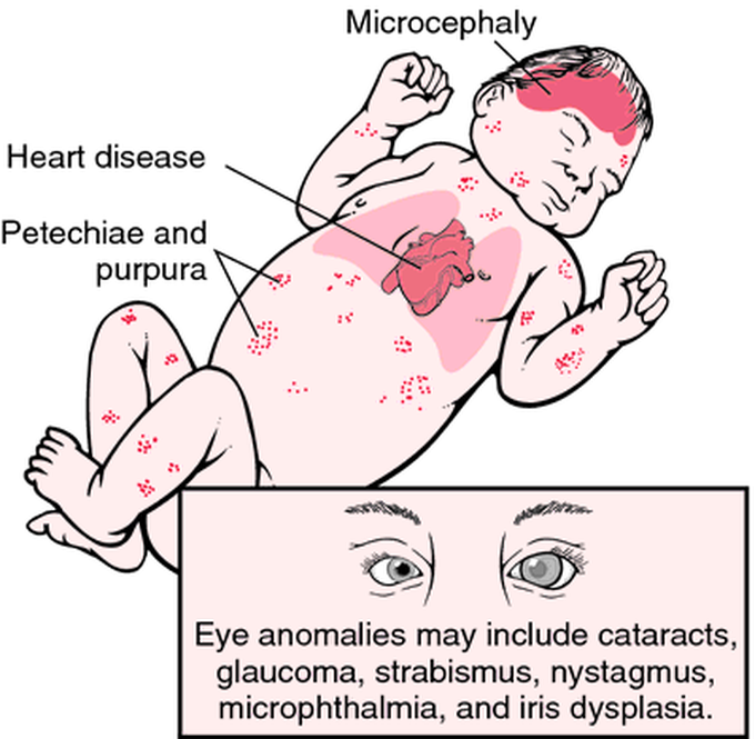 Rubella syndrome