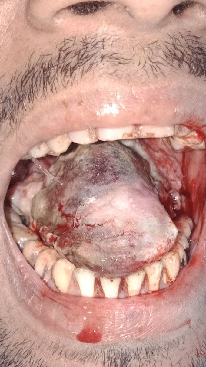 ORAL SQUAMOUS CELL CARCINOMA