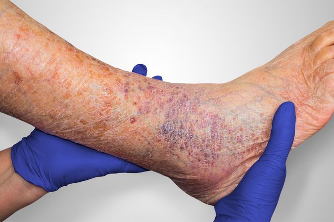 Treatment for Venous leg ulcer