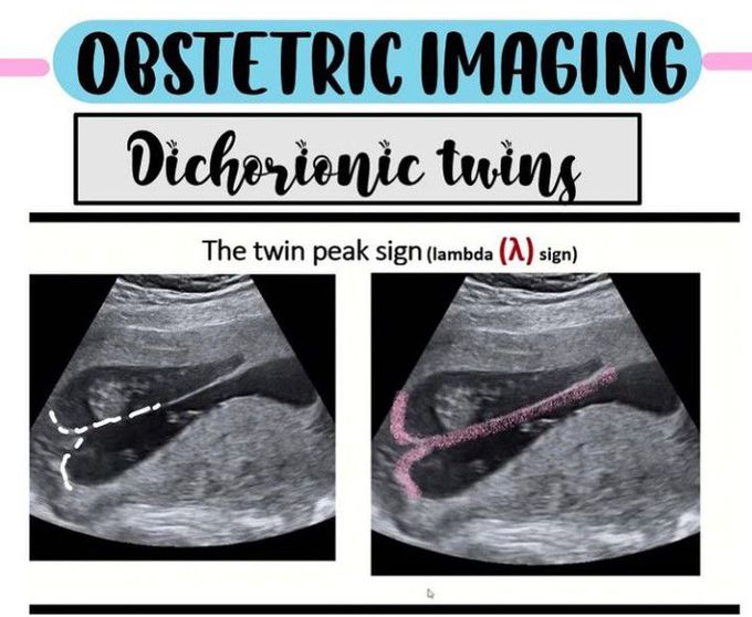 Dichorionic Twins