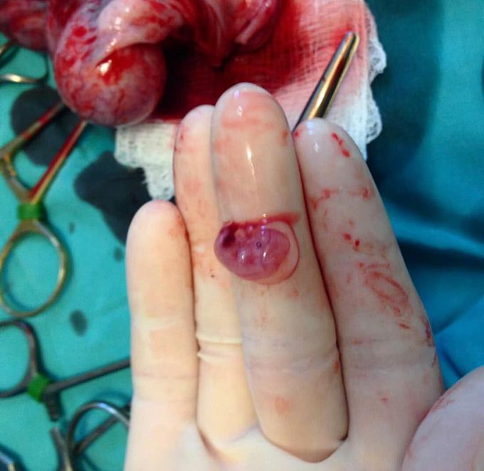 Tiny ectopic pregnancy extracted from a left fallopian tube!! 
