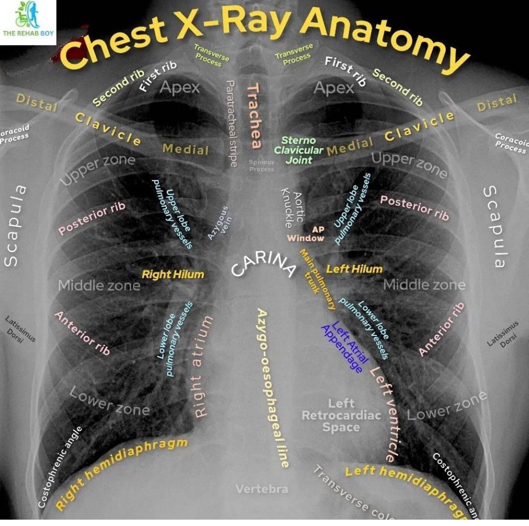 Chest X-ray Anatomy - MEDizzy