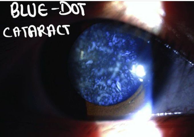 Blue Dot cataract
