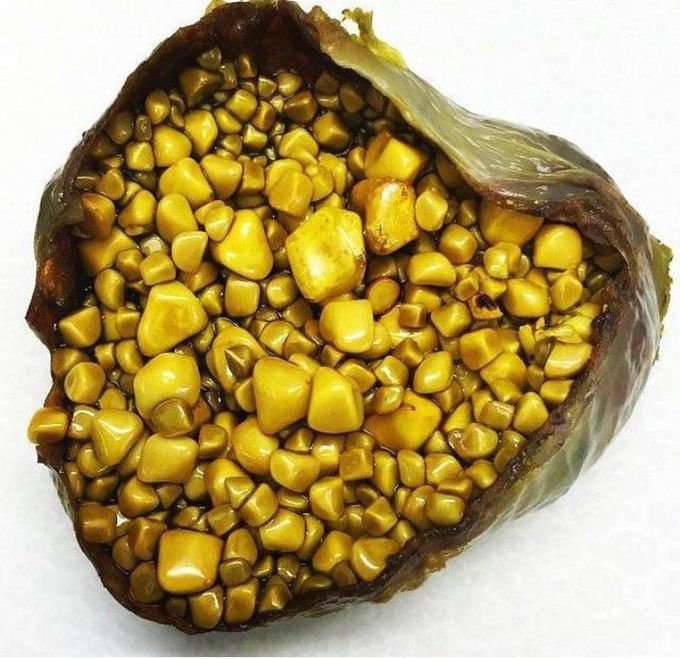 Cholesterol Gallstones