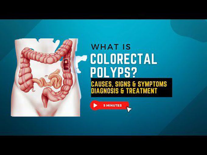 Colorectal polyps: Overview