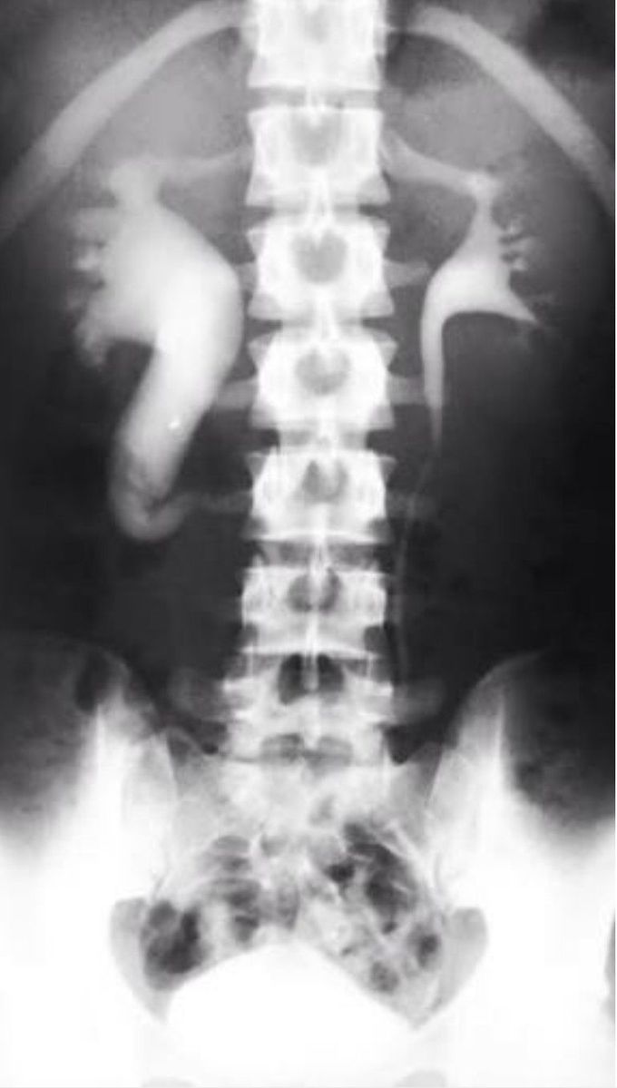 Renal day