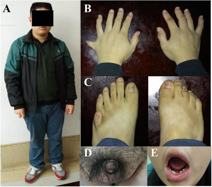 Signs and Symptoms of Laurence-Moon Syndrome