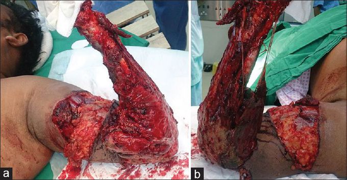 From the dorsal and volar aspect of the proximal stump. (a) From the volar side, the damage to the muscles including the pronator qudratus and avulsion of all the tendons, neurovascular structures, and soft tissue can be appreciated. (b) the dorsal wound showing a similar avulsion injury with few preserved musculotendinous units [inserting above the wrist (brachioradialis)] can be seen. Contamination can be appreciated