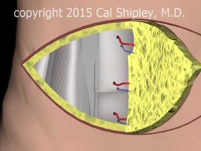 Breast DIEP procedure-
Animation