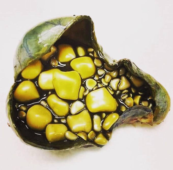 Gallbladder full of stones