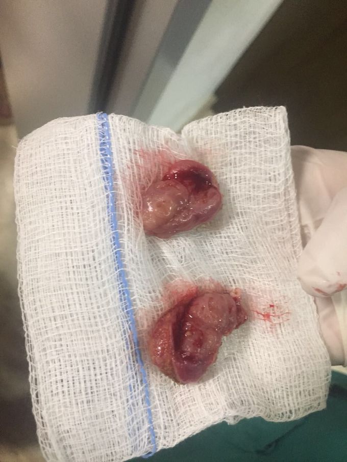 Tonsillectomy removal