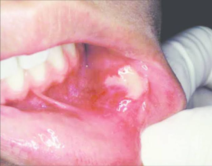 Herpetiform ulcers