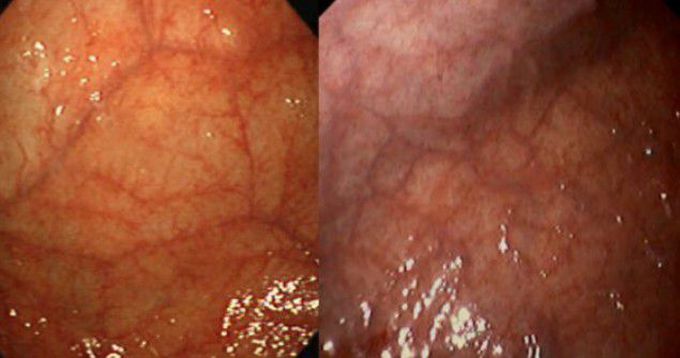 What do you think this stomach endoscopy is about?