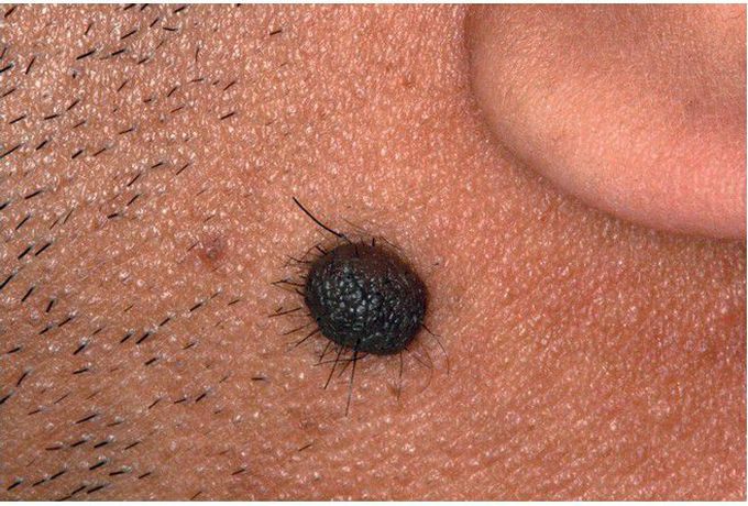 Melanocytic (Intradermal) Nevus