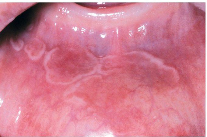 Erythema Migrans