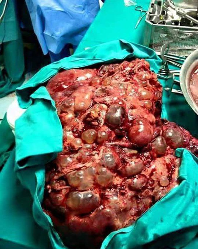 Polycystic liver disease (PLD or PCLD)