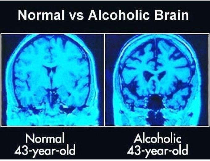 NORMAL VS ALCOHOLIC BRAIN