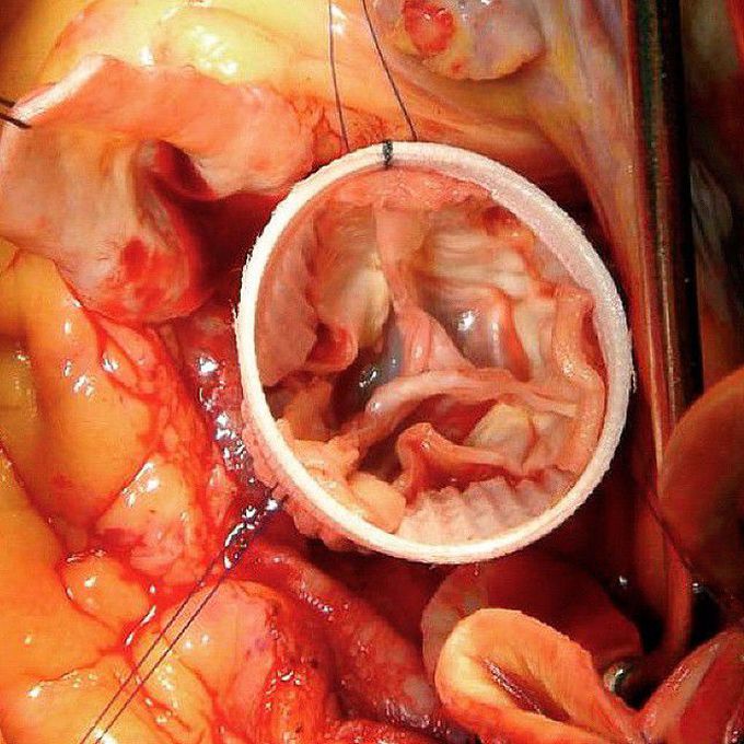 Appearance of the aortic valve leaflets following reimplantation with the Gelweave Valsalva graft.  