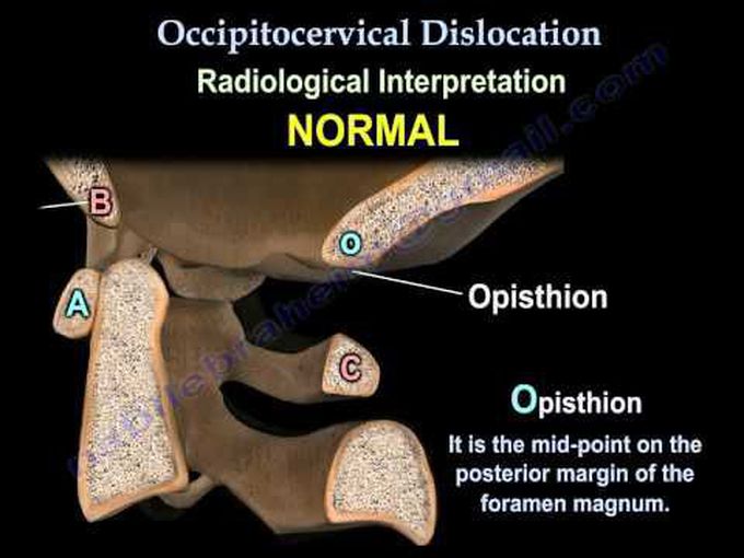 Occipitocervical Dislocation: Animation