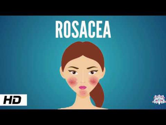 Pathology of Rosacea