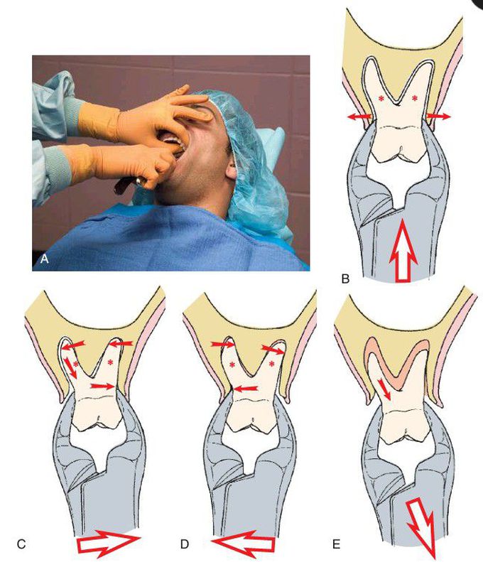 Extraction of maxillary molars