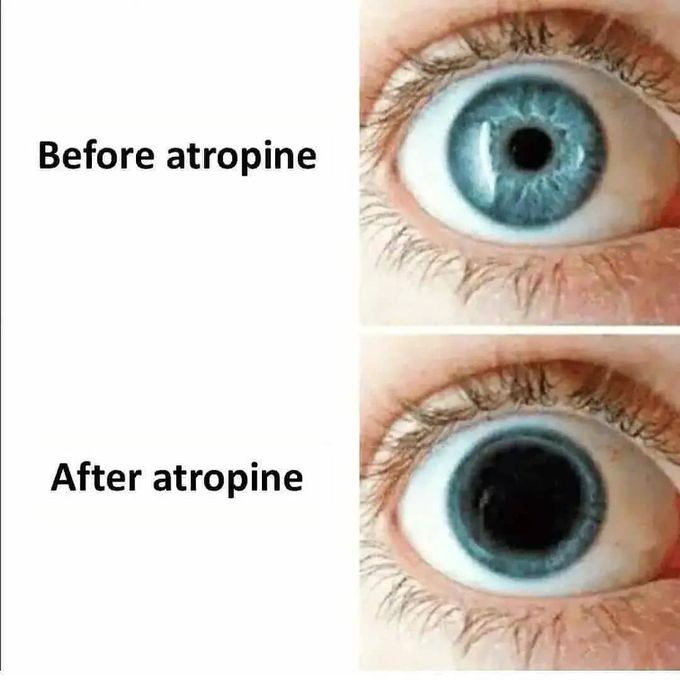 Mydriasis due to Atropine