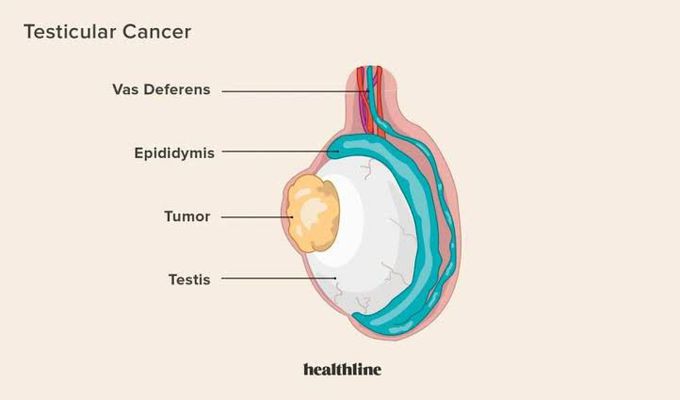 How to manage testicular cancer