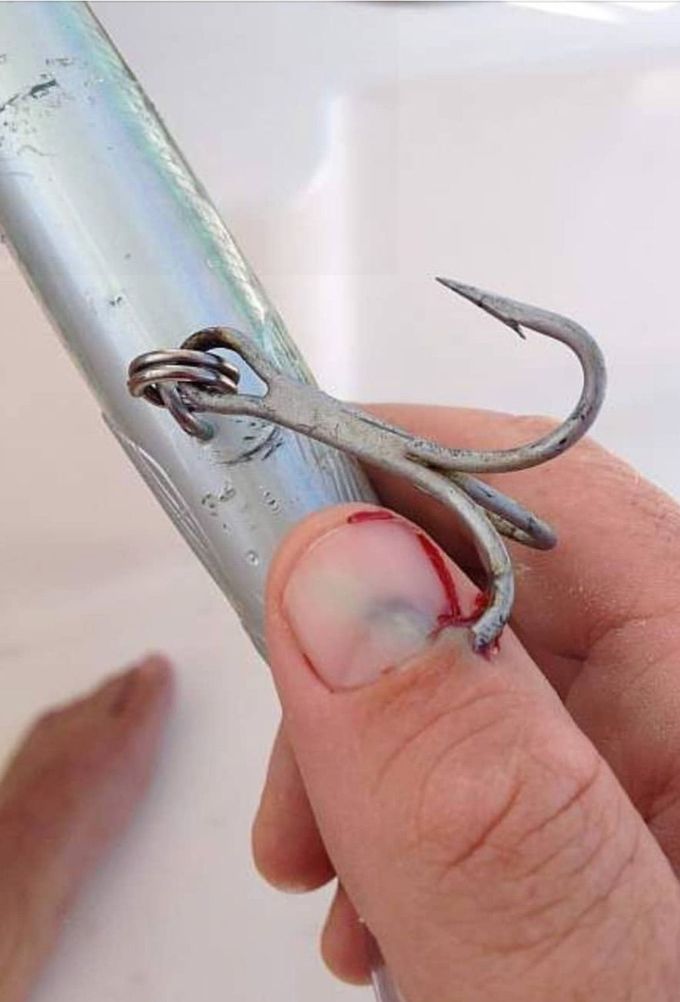 Fishhook injury!
