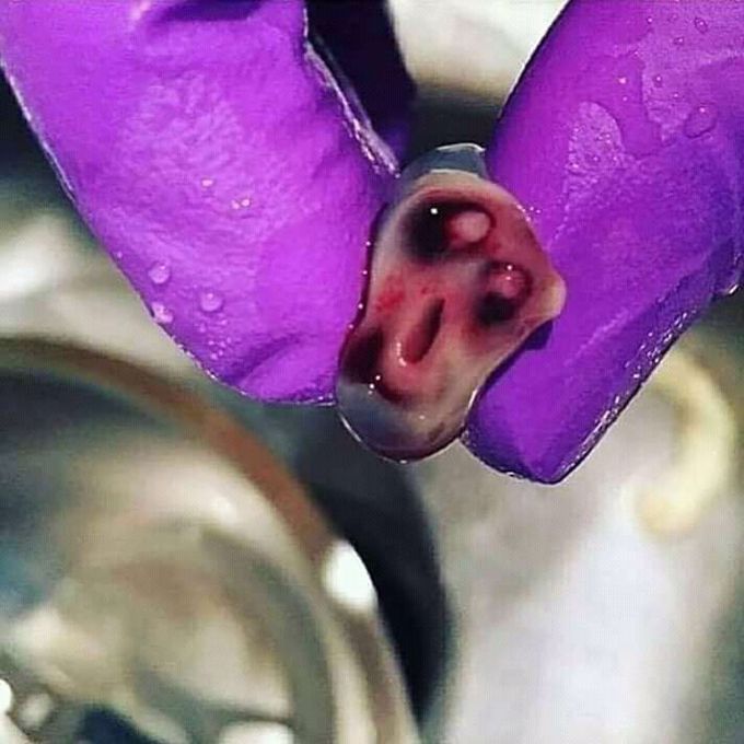 Fetal umbilical cord