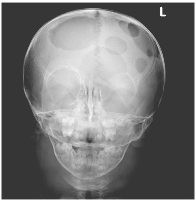 Langerhans'-Cell Histiocytosis