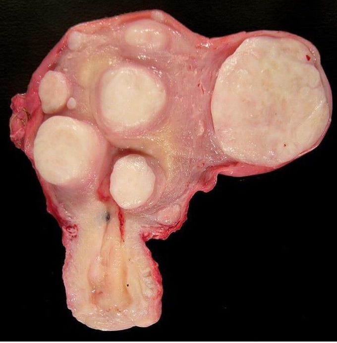 A uterus with multiple leiomyoma