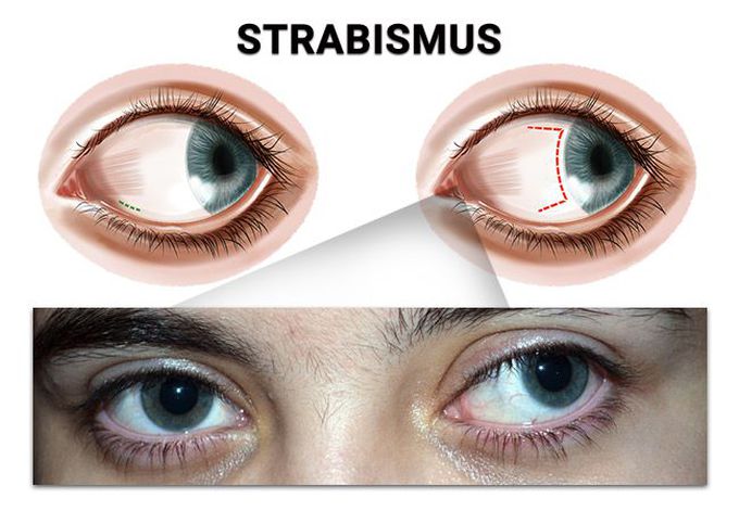 Strabismus