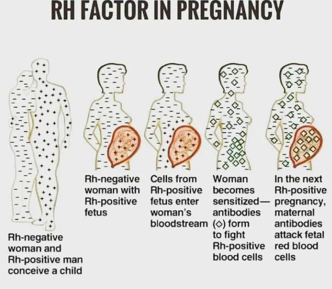 RH factor in pregnancy