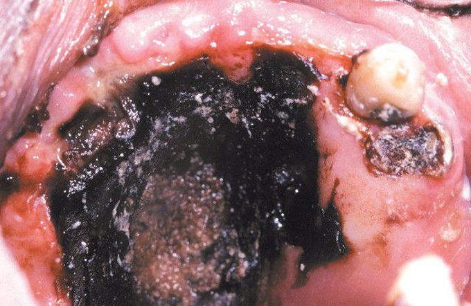 Mucormycosis