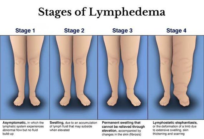 These are the stages of Lymphadema