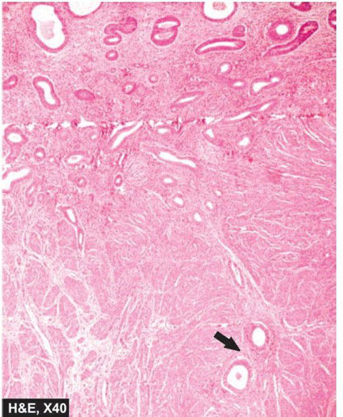 Adenomyosis