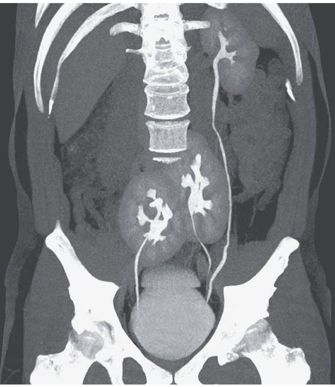 A Third Kidney