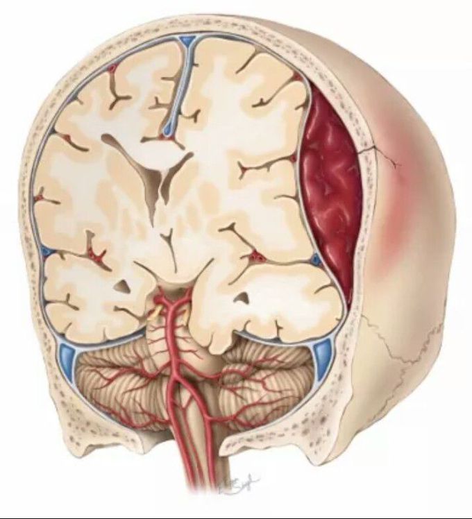 A patient presents to you in ER after a traumatic brain injury, showing lucid interval. What will be the most likely diagnosis?
