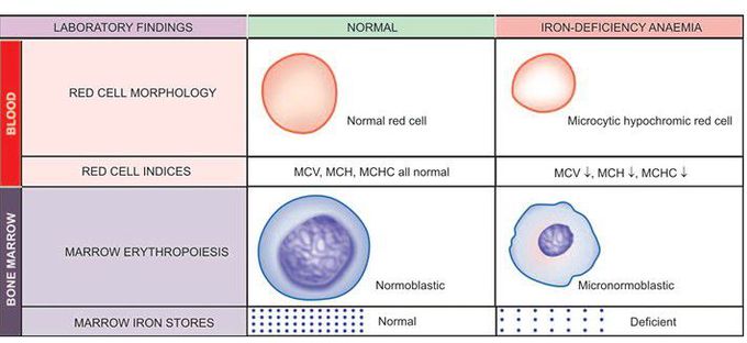 Iron deficiency anaemia.