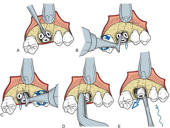 Extraction of carious maxillary roots