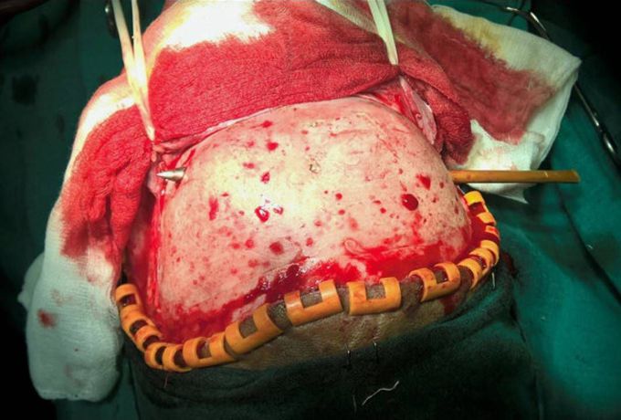 Arrow removed from patient's skull after terrible accident at archery club! 
