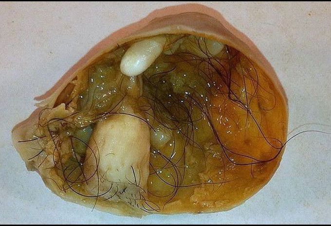 What do you know about teratoma?