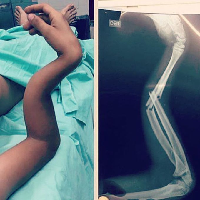 Where is the fracture?