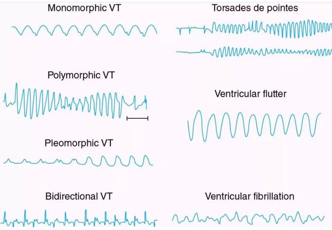 Common Ventricular Rhythms