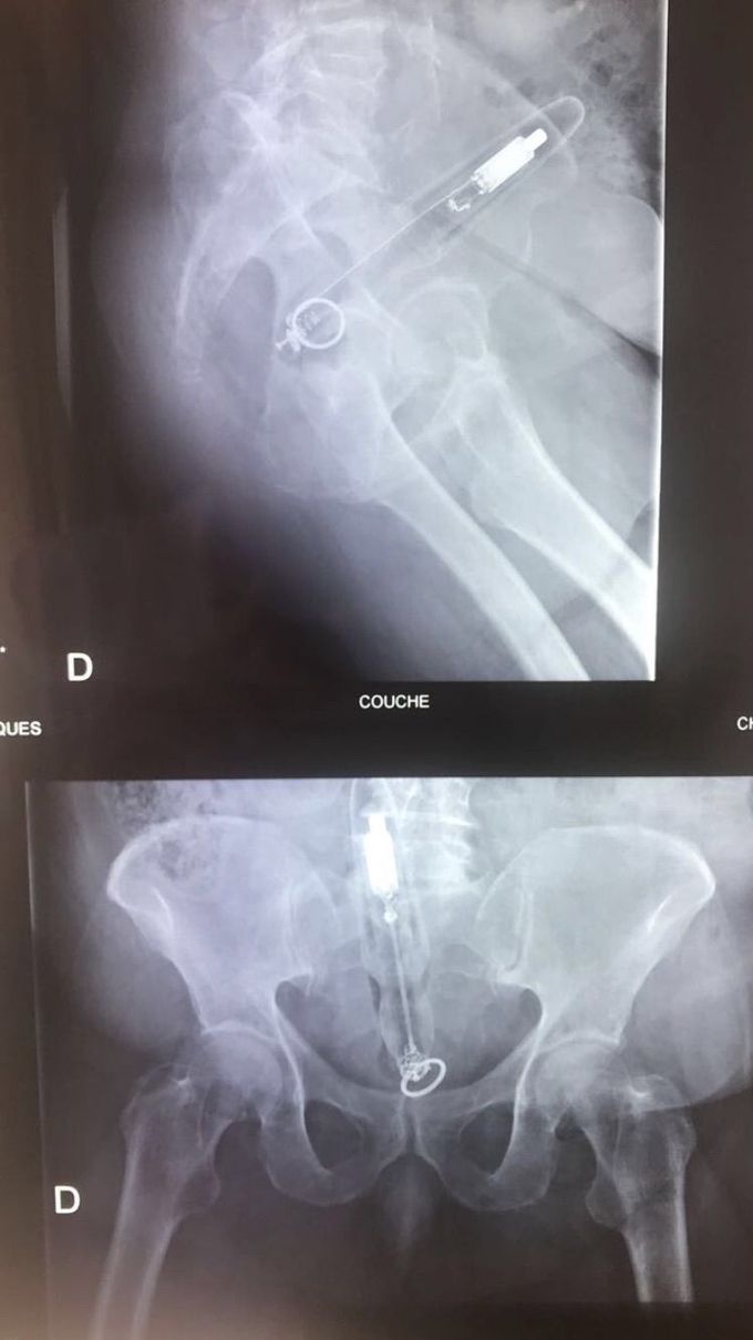 Diagnosis ?